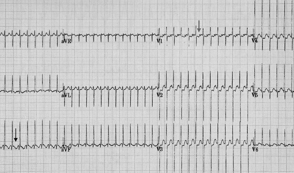 Un altro tipo di TRS dell età pediatrica è la Tachicardia Reciprocante Giunzionale Permanente (TRGP), assai più rara delle altre due, caratterizzata da una frequenza relativamente bassa e da un