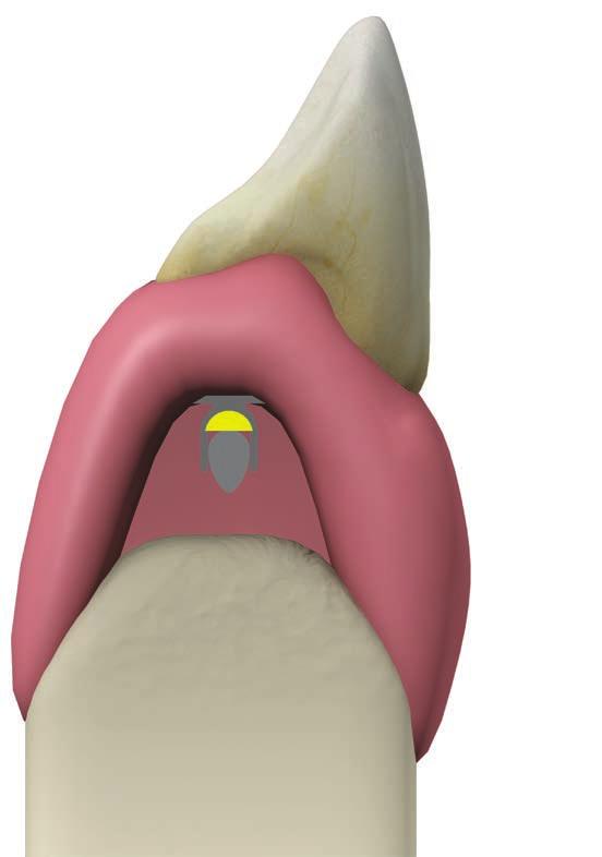 PROTOCOLLI DI UTILIZZO Barre fuse o saldate* La riabilitazione su barre costituisce un metodo di ancoraggio dell overdenture che ha anche il vantaggio di solidarizzare gli impianti tra loro.