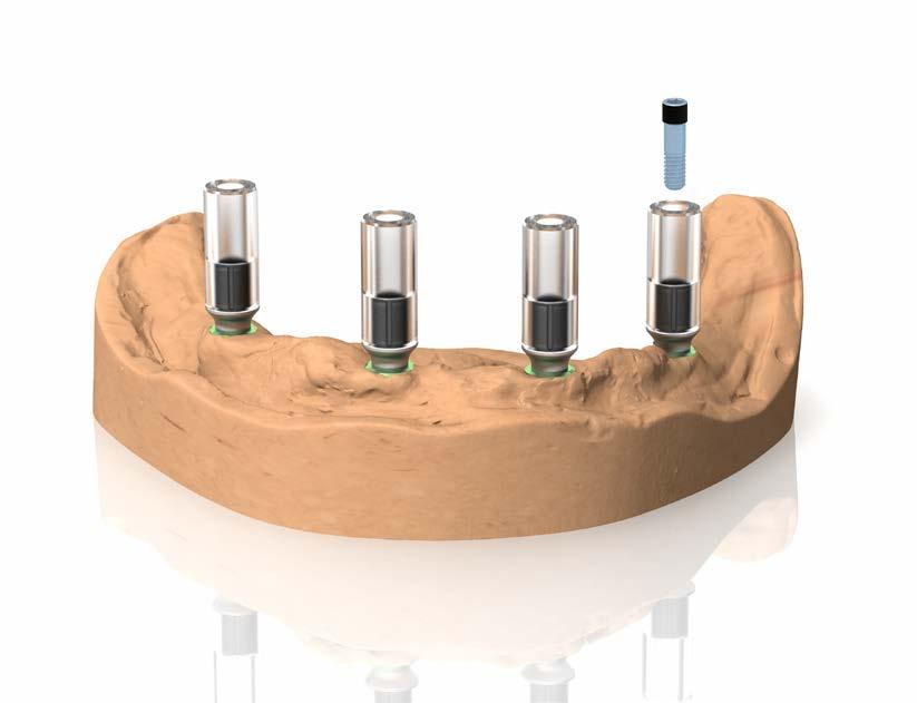 PROTOCOLLI DI UTILIZZO Barra ottenuta con pilastri calcinabili con base preformata in metallo: metodo indiretto Una volta realizzato il modello secondo le procedure standard, avvitare i pilastri