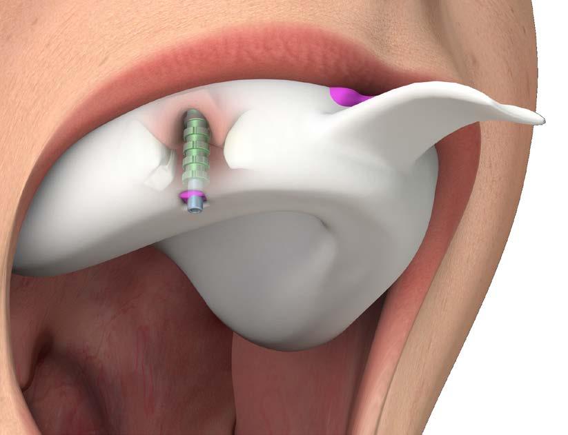 IMPRONTA A CUCCHIAIO APERTO Riempire il cucchiaio portaimpronta con materiale da impronta più consistente (SKY IMPLANT