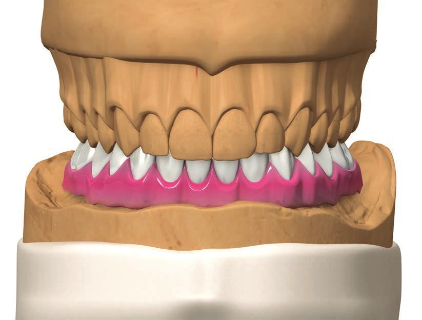 PROTOCOLLI DI UTILIZZO Tecnica Simple per la realizzazione di un provvisorio in resina per riabilitazione Full Arch Sul modello preliminare realizzare una ceratura diagnostica dell arcata edentula