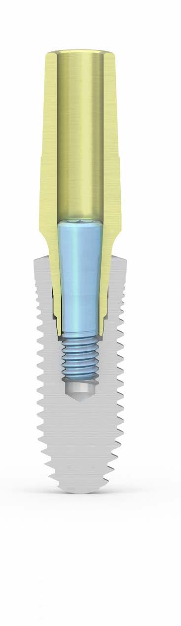 PROTOCOLLI DI UTILIZZO Riabilitazione definitiva con pilastri preformati I pilastri preformati sono prodotti in titanio Gr.