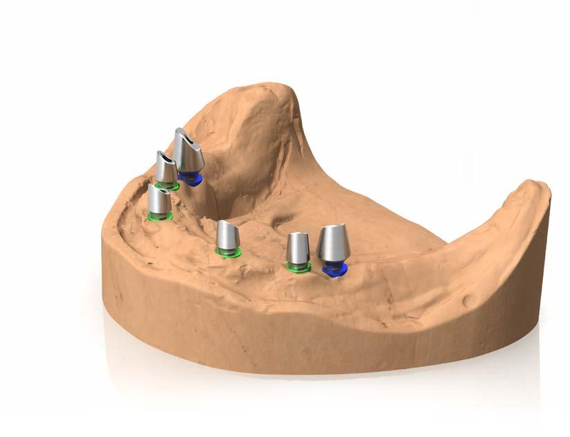 PROTOCOLLI DI UTILIZZO Riabilitazione definitiva Full Arch cementata su pilastri fresabili Sul modello di precisione inserire su ogni analogo un pilastro fresabile tra quelli disponibili a pag.73.