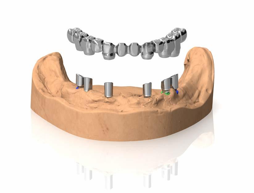 RIABILITAZIONE DEFINITIVA CON PILASTRICALCINABILI CON BASE IN METALLO Produrre la struttura Full Arch come di