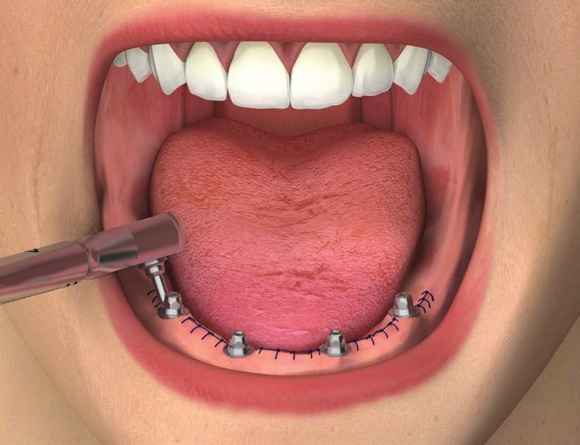 Poichè manualmente è difficile controllare con precisione il torque di inserimento delle componenti protesiche, è obbligatorio terminare la procedura sempre con