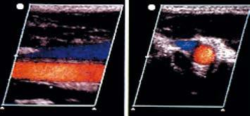 In vicinanza di confluenze venose o di nidi valvolari, come in particolari situazioni di stasi spontanea o provocata (compressione estrinseca, varicosi), è possibile visualizzare echi endoluminali