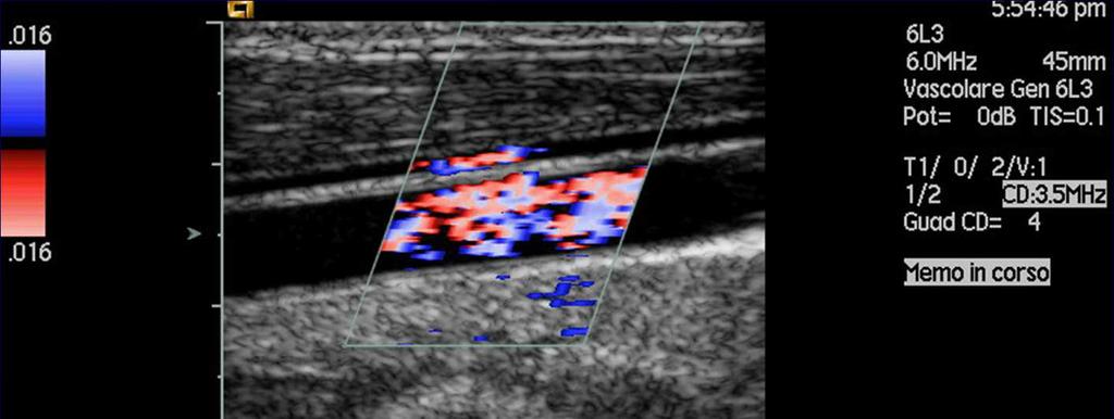 FREQUENZA d insonazione(fi) EFFETTO DOPPLER F= 2 v Fi