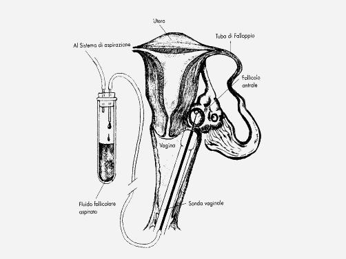 generale - Ridotto tempo operativo - Rischi minori - Maggiore accettabilità - Basso costo PRELIEVO FOLLICOLARE PMA LE