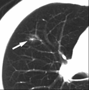 Type C adenocarcinoma in 64-yearsold man.