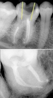com), è consulente endodontico per la rivista Oral Health e fa parte della redazione della rivista Endodontic Practice. Figura 3 L anatomia endodontica esiste su piani multipli.