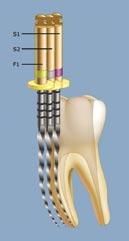Prevedibilità del successo endodontico: l approccio di tipo ibrido.