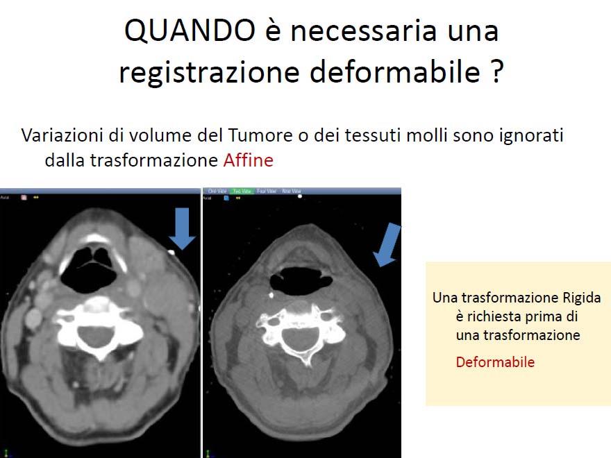 CONTOURING DEI GTV RINOFARINGEI