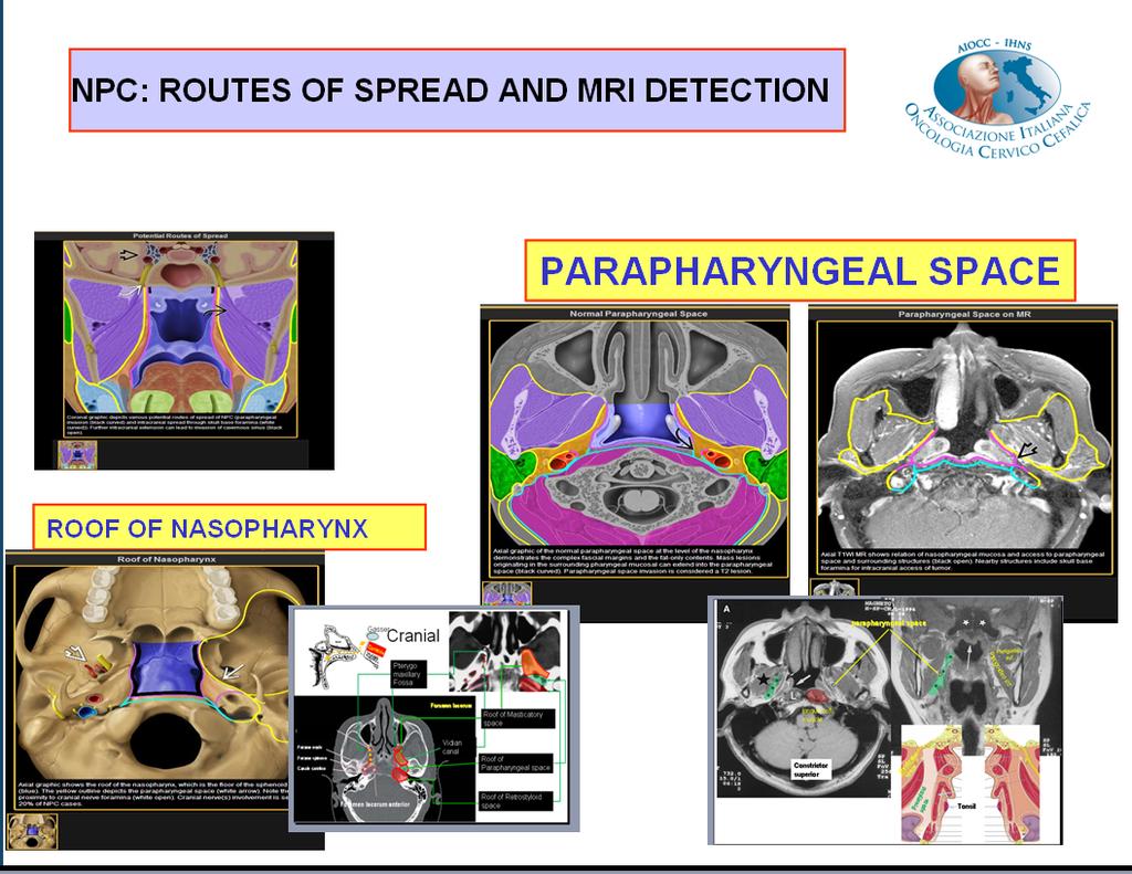RUOLO DELLA RM NELLA STADIAZIONE DEI TUMORI DEL RINOFARINGE RM in
