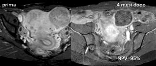 mestruale, i sintomi da effetto massa (pressione pelvica), la presenza di astenia o calo della concentrazione, la riduzione della libido, l irritabilità da anemia sideropenica, etc.