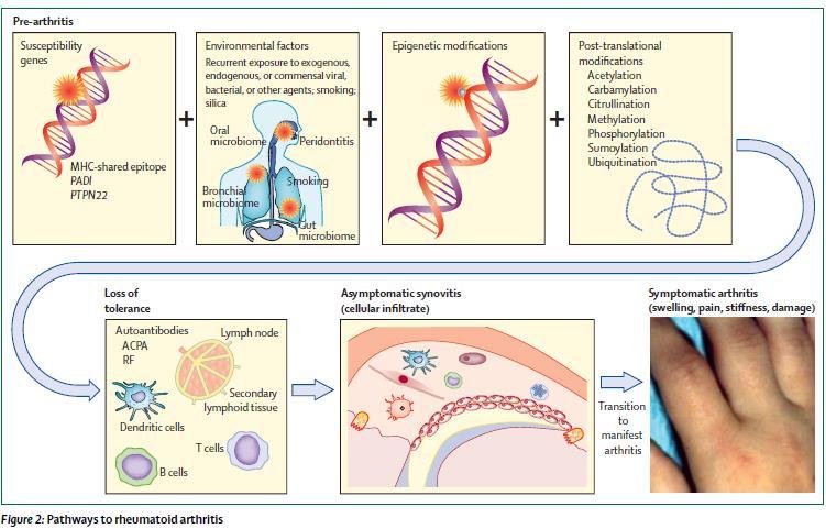 12 PATOGENESI L AR è patologia infiammatoria cronica e sistemica a patogenesi autoimmune. Sono molteplici i fattori eziopatogentici che caratterizzano questa malattia (figura 2).