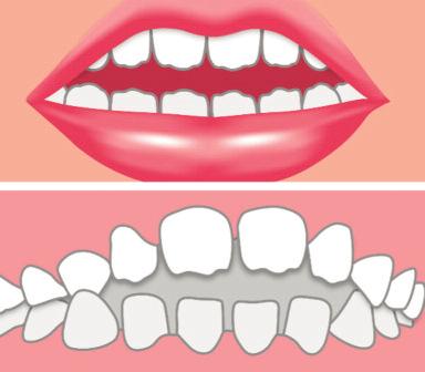 La forma, semicircolare, è ideale per accogliere i denti decidui e, grazie alla forze elastiche, è in grado di allineare i denti; inoltre aiuta a chiudere inconsciamente la bocca stimolando la