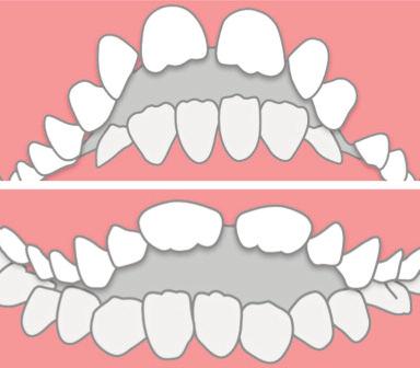 Rieducatori ORTHO-ALIGNER - OPEN BITE DENTIZIONE MISTA Lo scudo labiale nel superiore è esteso e più retroverso (35 rispetto all asse dentale); accoglie completamente gli incisivi