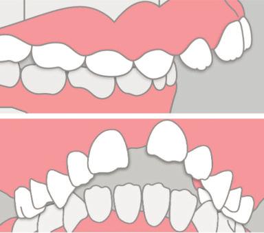 Il principio di funzionamento è sia indiretto, mediante l azione di contrasto della spinta linguale, sia diretto in quanto aiuta a guidare ed allineare i denti superiori in crescita.