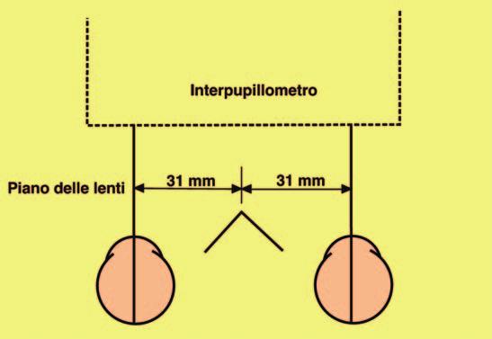 Esempio: OD -3.50 OS -3.50 6.00Δ base interna (180 ) Add OO +2.25 Le DAV monoculari sono entrambe di 31 mm. Introdurre le 6.00 Δ su OS lo fa ruotare verso l esterno di circa: 2 mm (6 x 0,3 = 1,8).