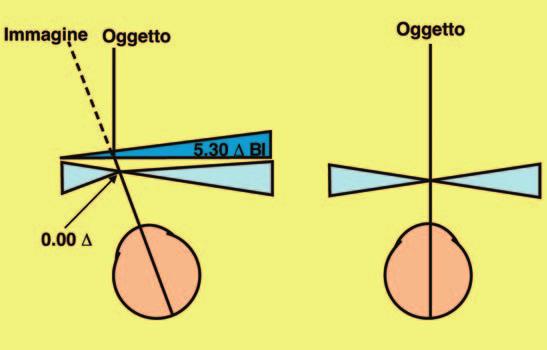 Poiché la lente è negativa l effetto prismatico è a base esterna. L effetto totale è quindi: 6.00 Δ base interna (prescritte) + 0,7 Δ base esterna (da decentramento) = 5,3 Δ base interna.