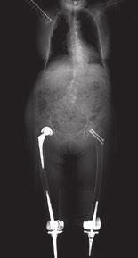 sostanze osteoconduttive, osteoinduttive, cementi o farmaci per curare l osso.