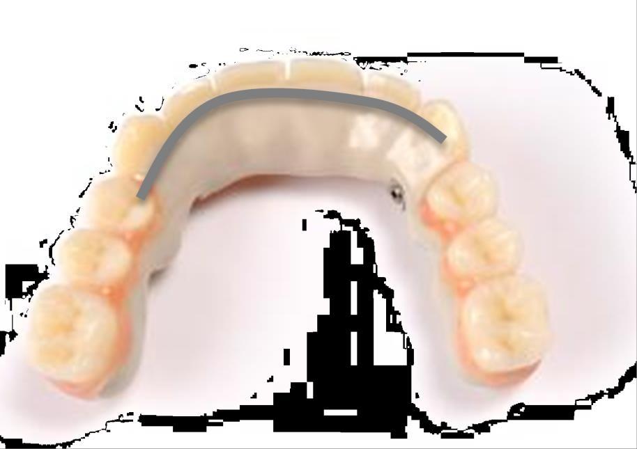 Protesi rimovibile Nel caso di protesi (telescopiche) rimovibili senza placca trasversale, deve essere applicata una placca di protezione almeno fino alla regione 13/23/33/43.
