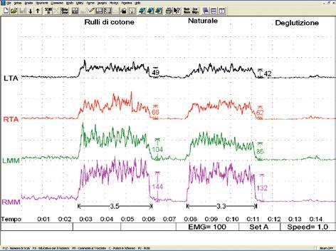 infatti una correlazione lineare tra segnale elettromiografico, reclutamento delle unità motorie e forza espressa in contrazione isometrica.
