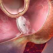 chiusura del PFO con crescita tissutale L'occlusore GORE CARDIOFORM Septal Occluder viene rilasciato all'interno del cuore formando due dischi opposti sui due lati del difetto, tra