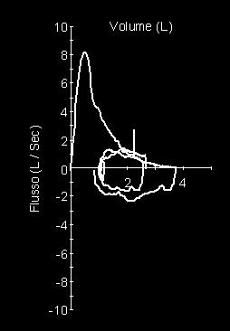 BASALE SPIROMETRIA POST BETA-2 STIMOLANTE (Salbutamolo 400 mcg MDI spacer) FEV1=56% FEV1 +21% 400 cc Criteri per la positività: aumento di FEV 1 o FVC del 12% ed almeno 200