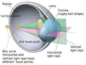 Un altro difetto di messa a fuoco è quello legato all astigmatismo, in cui la cornea non è esattamente sferica: i suoi raggi di curvatura non sono uguali.