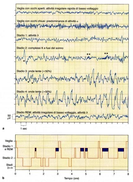 o i fusi del sonno, tratti in cui si osserva un progressivo aumento in ampiezza seguito da una progressiva riduzione in ampiezza di oscillazioni molto frequenti; gli stadi 3 e 4 sono gli stadi a onde