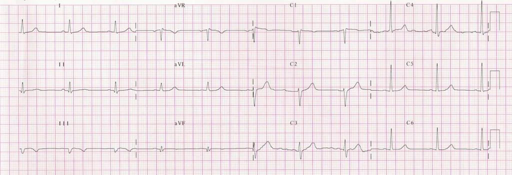 ECG