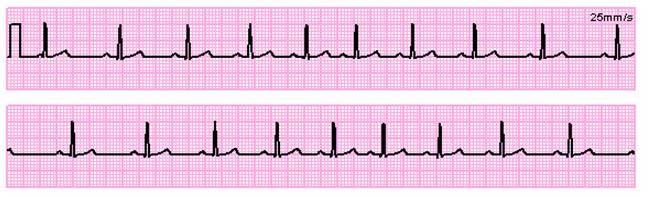 Aritmia sinusale Tutti i complessi sono normali Frequenza cardiaca irregolare: aumenta con