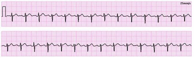 Tachicardia sinusale Tutti i complessi sono normali Frequenza superiore a 100bt/min (non supera 140bt/min) L aumento è provocato dall eccessiva stimolazione