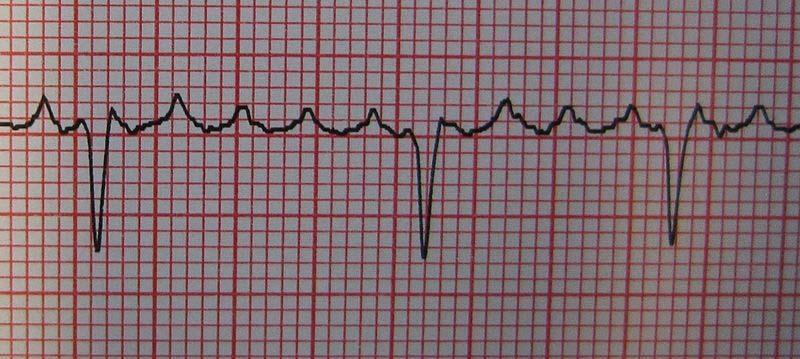 Flutter atriale Le onde P si succedono in forma tale che sulla carta assumono l aspetto di denti di sega (onde F), in quanto provengono da un foco diverso da quello sinusale ed a frequenza elevata