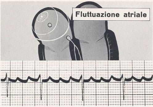 Flutter : sintomi Il Flutter atriale può svilupparsi in un cuore sano con alterazioni del sistema di conduzione, o in
