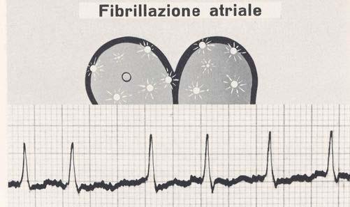 FA FA parossistica, che significa episodi di fibrillazione che occorrono improvvisamente e regrediscono in 24-48 ore FA persistente