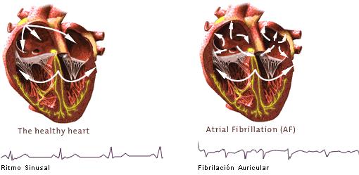 FA: trattamento Alto rischio tromboembolico,iniziare terapia anticoagulante (TAO = coumadin) Cardioversione elettrica (FA di recente insorgerza o in