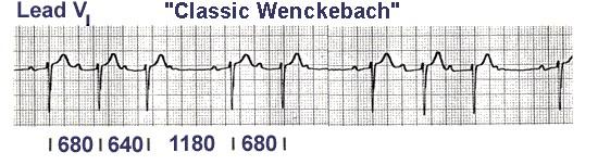 BAV II Mobiz 1 (Luciani-Wenckebach) Le P sono presenti Il PR si allunga progressivamente finchè una P non è bloccata e non è seguita dal complesso QRS.