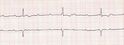 BAV III (BAV TOT) Le P sono presenti ma nessun impulso atriale P è condotto ai ventricoli, dissociazione AV completa.
