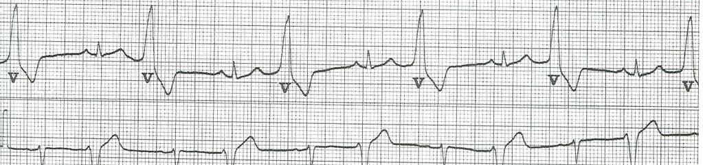 EXTRASISTOLI VENTRICOLARI BIGEMINISMO Pg 247