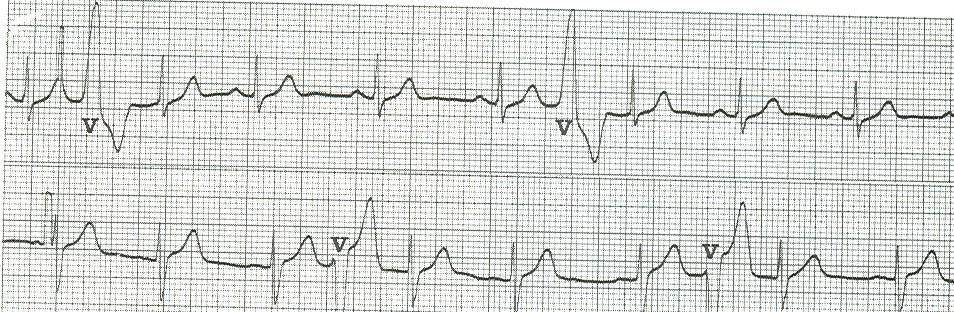 EXTRASISTOLI VENTRICOLARI INTERPOLATE Pg