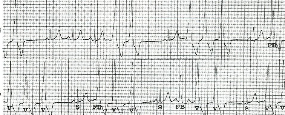 EXTRASISTOLI VENTRICOLARI Coppie e triplette Da 2