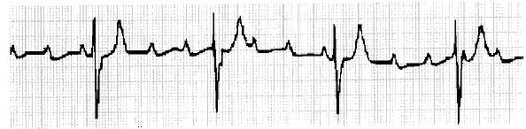 BLOCCO AV DI 3 No impulse conduction from the atria to the ventricles