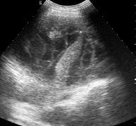 6 - Versamento anecogeno (V): si noti il polmone (P) collassato e l aorta toracica (AO) in scansione trasversale V P Fig.