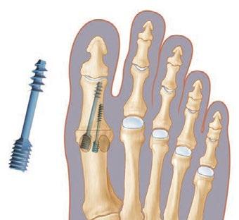 Viti cannulate per osteotomie del piede anteriore Artrodesi dell alluce Filetto differenziale, vite cannulata di grande diametro con guida fissata su filo K.