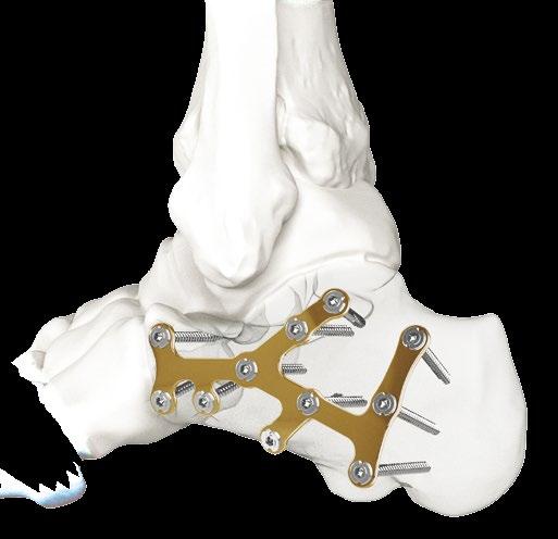 Mercury - Supporto calcaneale Il calcagno è l osso tarsale più frequentemente fratturato, e tali fratture possono essere generalmente classificate in intra-articolari (70-75%)