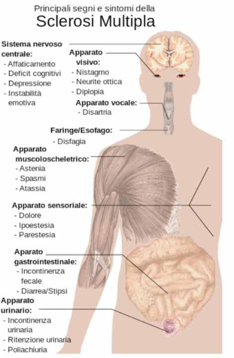 Nella SM il danno mielinico interferisce con la trasmissione dei segnali nervosi tra cervello, midollo spinale e altre aree somatiche: tale alterazione della trasmissione nervosa causa i sintomi