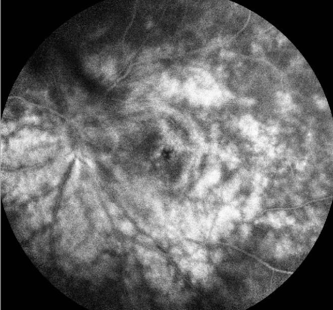 metamorfopsia BCVA: 2/10 Esame clinico: retina ovunque sul piano,emc, assenza di segni di flogosi