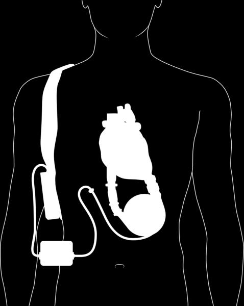 L'obiettivo è quello di controllare il sistema e poterne regolare la portata per soddisfare la domanda metabolica del paziente.